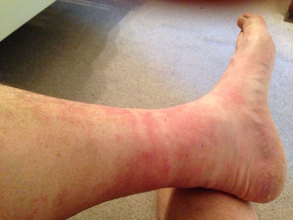 Blotchy Ankles Truly One foot in front of the other PCT Edition
